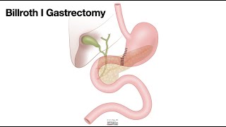 HCC 147510bSurgical AnatomyBillroth I [upl. by Aidnic]