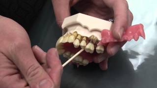 What is Periodontal Disease [upl. by Stanislas130]