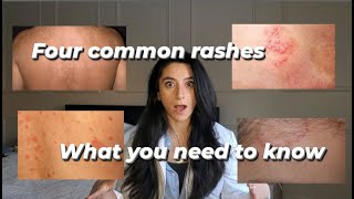 Four common rashes and everything you need to know about them [upl. by Clementis]