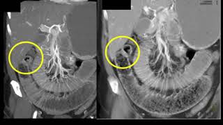 Stools stuck in abdomen  Small Intestinal Obstruction Dr Rajasekhar M R  Doctors Circle [upl. by Eiznik]