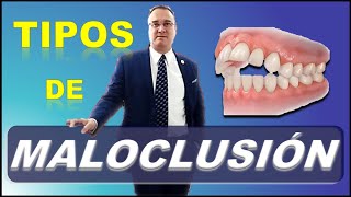 TIPOS DE MALOCLUSION DENTAL  FACTORES QUE CAUSAN [upl. by Annaeerb792]