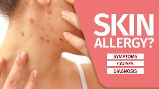 What is Skin Allergy Symptoms Causes Diagnosis and Triggers [upl. by Behlke]