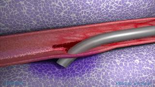 Peripheral IV Infiltration Animation [upl. by Nnylorac]