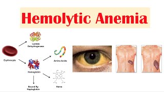 Hemolytic Anemia [upl. by Mara377]