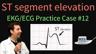 ST Elevation  EKG  ECG Interpretation Case 12 STEMI MI ACS [upl. by Aneerbas]