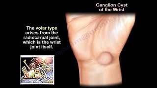 Ganglion Cyst Wrist  Everything You Need To Know  Dr Nabil Ebraheim [upl. by Auqenahc]