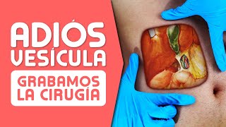 LA VESÍCULA ¿Cuándo es Mejor OPERAR Síntomas Cálculos Pólipos y Cáncer [upl. by Woolcott96]