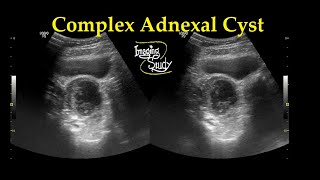 Hemorrhagic cyst  Medical Meaning [upl. by Neelrihs]