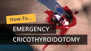 Emergency Cricothyroidotomy using CricKey [upl. by Ahsiekahs]