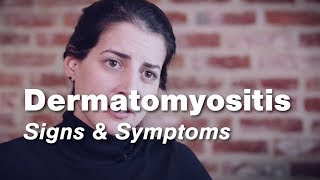 Dermatomyositis – Signs amp Symptoms  Johns Hopkins [upl. by Annirok]