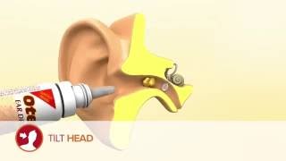 How to use Otex Ear Drops [upl. by Naget534]