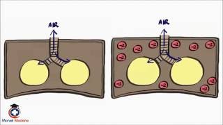 Pneumothorax and Tension Pneumothorax [upl. by Wrennie]