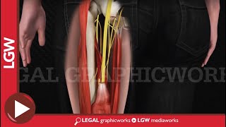 Hamstring Repair Surgery 3D animation [upl. by Nwahsud]