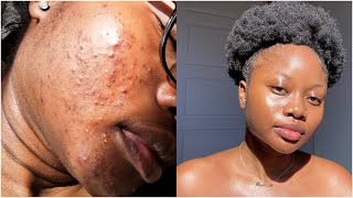 my skincare routine for acne amp scars finally [upl. by Phene]