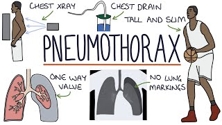 Pneumothorax [upl. by Shawn]