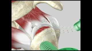 Arthropathy  Joint Pathology Classification [upl. by Ennoval]