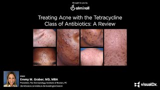 Treating Acne with the Tetracycline Class of Antibiotics A Review [upl. by Wilone]