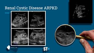 Renal Cysts Ultrasound [upl. by Leelaj]