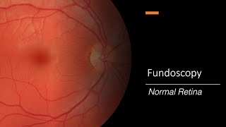 Healthy Retina Fundoscopy [upl. by Ybrek]