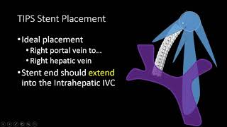 TIPS Stent US Doppler Evaluation [upl. by Airad]