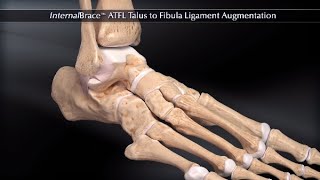 InternalBrace™ ATFL Talus to Fibula Ligament Augmentation [upl. by Minsk]