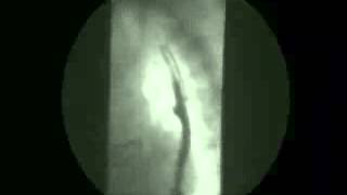 Video 8  Gastroesophageal reflux [upl. by Asta426]