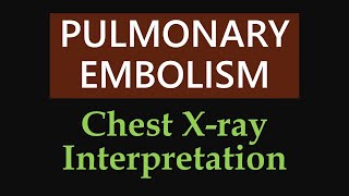 Pulmonary Embolism  Chest Xray Interpretation [upl. by Aloz]