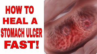 How to Heal a Stomach Ulcer Fast How to Fix a Stomach Ulcer [upl. by Notserk990]