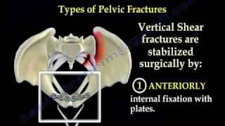 Pelvic Fracture Overview  Everything You Need To Know  Dr Nabil Ebraheim [upl. by Ardie]