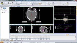 Setting Up a Plan for Multiple Brain Metastasis using Monaco [upl. by Millwater]