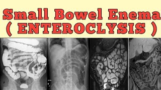 Small bowel enema  Enteroclysis [upl. by Alroy]