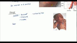 Staphylococcal Scalded Skin Syndrome SSSS and Bullous Impetigo [upl. by Nosyk62]