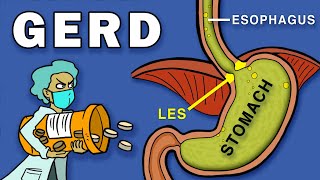 Gastroesophageal Reflux Disease GERD [upl. by Auqinahs82]