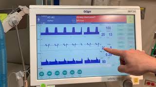 Introduction to a Drager Ventilator [upl. by Ecirad]