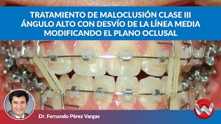 Tratamiento de Maloclusión Clase III Ángulo alto Desvío de línea media cambiando el plano oclusal [upl. by Salvucci542]