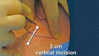 Cricothyrotomy [upl. by Wylma520]