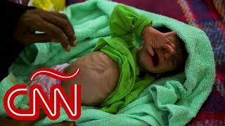 Niños mueren de hambre por desvío de ayuda humanitaria en Yemen [upl. by Hadeehsar104]