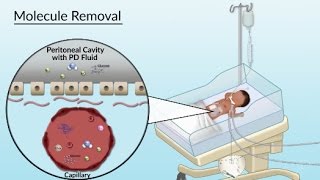 Peritoneal Dialysis by S Su A Olszewski  OPENPediatrics [upl. by Thomajan173]