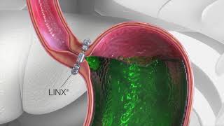 LINX Reflux Surgery Animation [upl. by Appilihp]