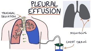 Understanding Pleural Effusions [upl. by Inanak191]