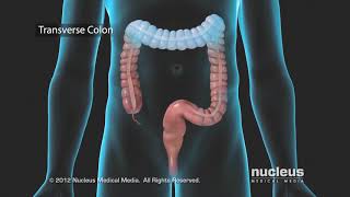 Colon Problems Diverticular Disease [upl. by Chloette92]