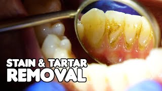 Dental Cleaning EXPLAINED  Stain amp Tartar Removal [upl. by Huoh]