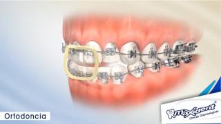 Corrección de mordida y espacios dentales quotOrtodonciaquot [upl. by Lucania]