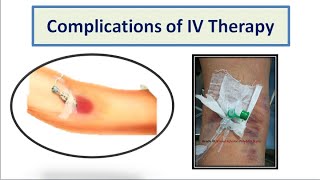 Complications of IV Therapy [upl. by Sklar717]