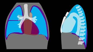 Pneumothorax Explained by Prometheus Lionhart MD [upl. by Nuncia]