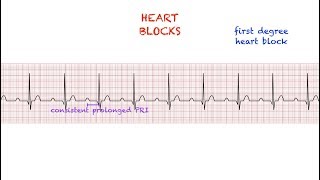 Heart Blocks Interpretation Easy and Simple [upl. by Eetnod]