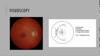 Papilledema Fundoscopy [upl. by Avril]