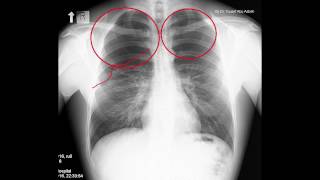 Pneumothorax Radiology in two minutes [upl. by Nhguaval]