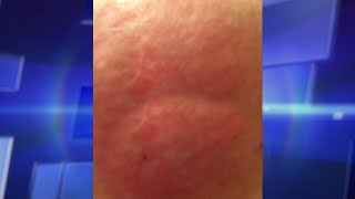 Skin Rash Leads to Shocking Diagnosis [upl. by Emilia]