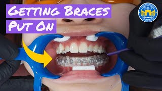 Process of Getting Braces [upl. by Blainey]